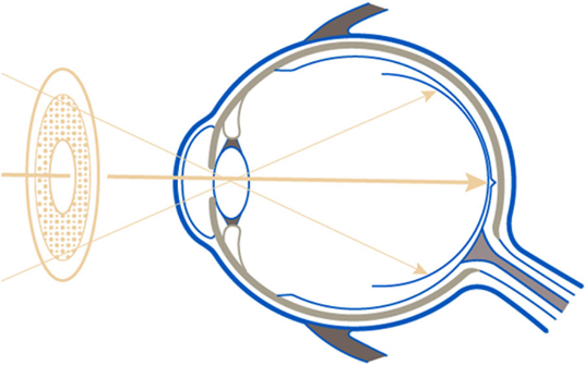 soczewki okularowe MiYOSMART Hoya z technologią DIMS